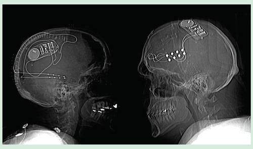 Figure 4. Skull x-rays of two patients implanted with the RNS® neurostimulator and NeuroPace® leads. The patient on the left is a female, with seizures arising bilaterally from the mesial temporal lobes. The x-ray shows NeuroPace depth leads implanted longitudinally in the left and right hippocampi. The Leads are connected to the RNS neurostimulator shown implanted in the parietal bone. The patient on the right is a male, with seizures arising from the left frontal lobe. The x-ray shows NeuroPace cortical strip leads implanted over the left frontal lateral cortex. The leads are connected to the RNS neurostimulator implanted in the parietal skull.