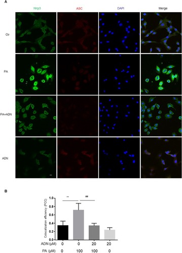 Figure 6 The effect of AdipoRon on ameliorating PA-induced formation of Nlrp3 inflammasome. (A) Representative fluorescent microscopic images showing the colocalization of Nlrp3/ASC. (B) Summarized data showing PCC of Nlrp3/caspase-1 and ASC (n= 4). Data are expressed as the mean ± SD. **P < 0.01, ##P < 0.01 vs. PA group. Bar = 20 µm.