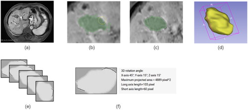Figure 2. Postoperative MRI image processing. (a) Selecting MRI sequence; (b) Using the threshold function that comes with 3Dslicer to delineate AZ; (c) Correcting the outline of AZ manually; (d) Generating the 3D-shape of AZ automatically; (e) Rotating and projecting the 3D-shape to find the section with the largest area as the standard section of AZ; (f) Calculating the AZ length width and area. AZ: ablation zone.