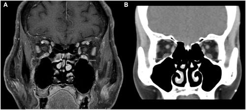 Figure 1 (A) Coronal contrast-enhanced T1-weighted orbital magnetic resonance imaging with fat suppression (CE-T1W/FS) in a patient with myasthenia gravis. (B) Coronal orbital computerized tomography scan in a patient with myasthenia gravis. The thickest part of bilateral inferior rectus muscles was measured (white line) in both cases.
