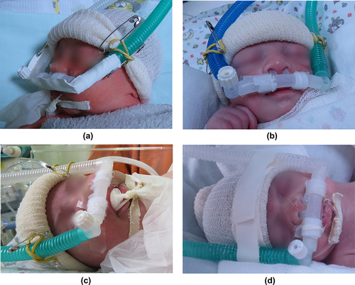 Figure 4 Difficulties reported during the use of NIV in the NBs (a) Use adhesive tape or elastic bandage to maintain the circuit connection (b) Difficulty with existing short binasal prong sizes (c) Use of hydrocolloid on the nasal region and the pacifier made with a glove due leakage through the nostrils and mouth (d) difficulty with fixing the tracheas using the pin and elastic in the tubular mesh, necessary to change fixation for adhesive tape.