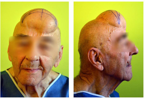 Figure 1 Giant lipoma of the head - patient before surgery.