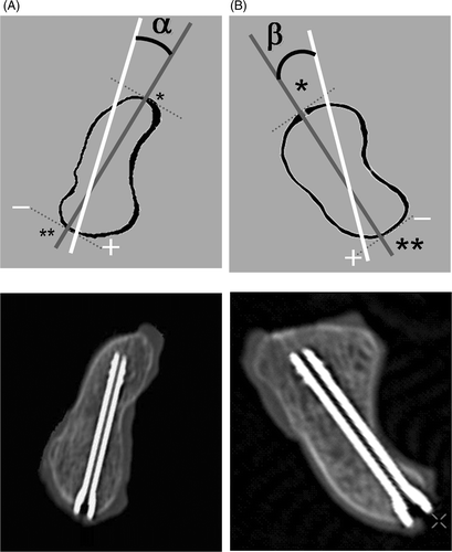 Figure 5. Method for calculating precision of screw placement on the basis of anteroposterior (AP) and lateral X-ray images of the scaphoid following the calculation by Liverneaux et al. Citation[6]. The gray line represents the scaphoid axis and the white line the screw axis. (A) Angle α represents the angle between the scaphoid axis and the screw axis in an AP X-ray image; α is positive when the entry point of the screw is medial in relation to the axis, and negative when the entry point is lateral in relation to the axis. (B) Diagram of the scaphoid in lateral view. Angle β represents the angle between the scaphoid axis and the screw axis in a lateral X-ray image; β is positive when the entry point of the screw is posterior in relation to the axis, and negative when the entry point is anterior in relation to the axis.