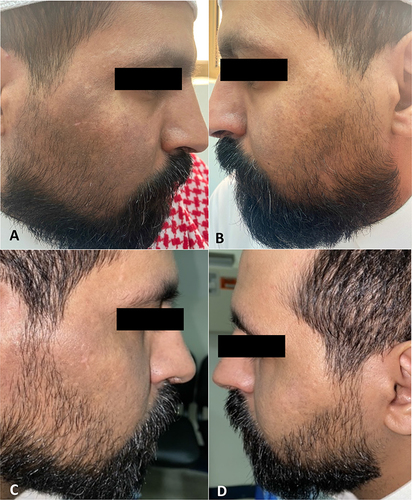 Figure 1 (A and B) Poorly demarcated greyish-brown confluent macules and patches associated with fine rough scales on the right cheek and the left cheek respectively. Lesions on the right side are darker and more diffuse compared to the left side. (C and D) Sites of the lesions after using ivermectin 1% cream daily at 3-month follow-up, significant improvement in discoloration and texture on the right cheek and the left cheek respectively.