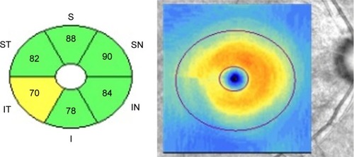 Figure 1 The Cirrus HD-OCT macular cube 200×200 protocol provides regional GCIPL thickness in six wedge-shaped sectors.