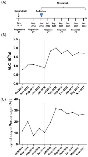 Figure 4. The circulating lymphocyte counts during treatment.A detailed clinical timeline is displayed (A). The results of ALC and LYM% in peripheral blood are displayed in accordance with the aforementioned treatment timeline. A dramatic increase in ALC and LYM% was observed after treatment with RT and nivolumab (B and C). The ALC at the bottom of 780/μl on June 2, 2016, demonstrated a dramatic rise to 2,000/μl on August 7, 2016, and thereafter was maintained at high levels (B). After combined therapy, the LYM% increased gradually, up to 31.6% and maintained at a high level throughout treatment (C).