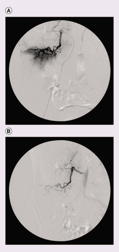 Figure 2. Selective angiography of the right lumbar artery. (A) Prior to embolization, shows vascularization of the cranial portion of the iliac metastasis and (B) postembolization, shows devascularization of the cranial portion of the lesion.