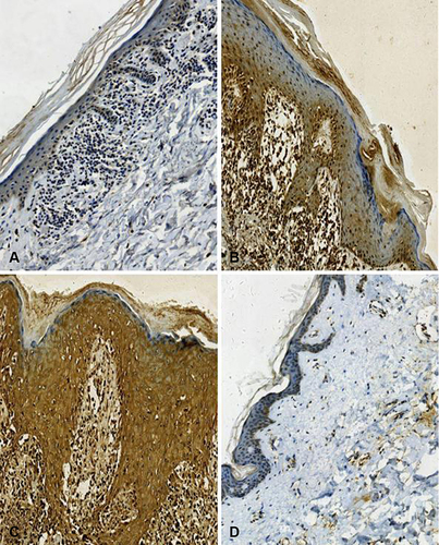 Figure 2 Immunohistochemical staining of TNF-α in case group (Brownish-yellow particles in the cytoplasm) (A) TNF-α weak staining (magnification, x200), (B) TNF-α moderate staining (magnification, x200), (C) TNF-α strong staining (magnification, x200), (D) TNF-α negative staining in control group (magnification, x200).