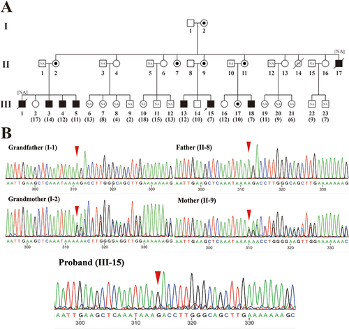 Figure 1 (A) Pedigree information of family 1 with DMD. The proband is marked with a black arrow. Black-filled squares represent patients. Slashes represent deceased family members. Circles with black dots represent female carriers. NA indicates the family members did not perform WES or Sanger sequencing. The numbers in parentheses represent the age of the family members. (B) Sanger sequencing results of the proband, his parents and grandparents. The red triangle indicates the mutation site (c.6963del). Both the mother and grandmother of the proband are mutant carriers.