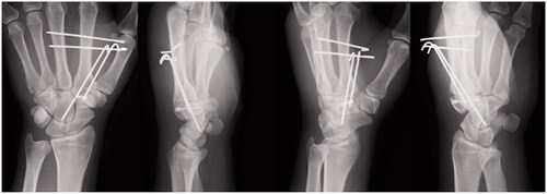 Figure 4. Postoperative X-ray images after surgical fixation of an isolated left trapezoid coronal shearing fracture in a 40-year-old male. The fracture was reduced and fixed with a double-threaded screw (DTJ mini screw, Meira Co., Ltd., Nagoya, Japan; width proximal 3.4 mm, distal 2.7 mm, length 20 mm). Kirschner wires were used to reduce the pressure on the trapezoid.