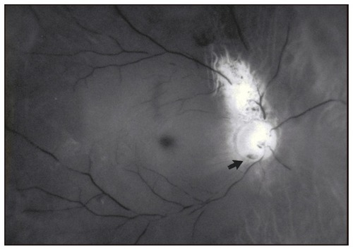 Figure 1 Fundus photo with a temporally located optic disc pit (arrow) and associated macular detachment. There is chorioretinal atrophy superior to the nerve.