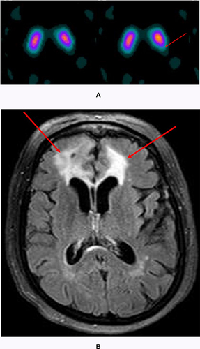 Figure 2 A typical pattern of abnormality seen in the left posterior putamen (arrow) of a patient with essential tremor (A) and correlating axial T2/FLAIR slice on MRI (B). The patient is status post left frontal resection of a midline meningioma in the left frontal convexity. Image B shows vasogenic edema of the bilateral frontal lobes (arrows).