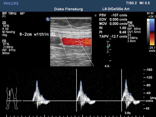 Figure 5. Duplex ultrasound at 12 months post-procedure for the case presented in Figure 4.