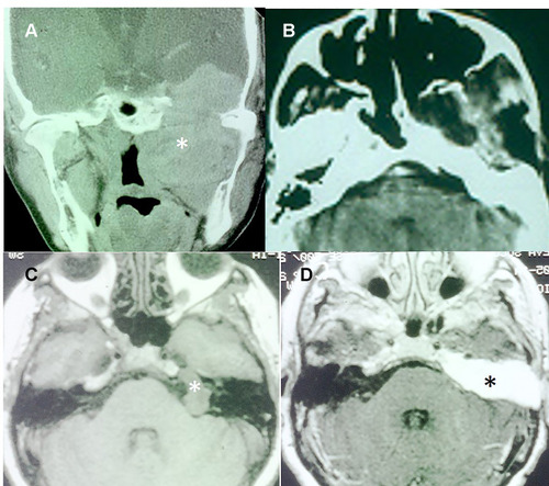 Figure 1 Surgical approaches in trigeminal schwannomas: subtemporal-preauricular and transcochlear. (A) Type ME2 TS with massive involvement of the middle cranial fossa and the infratemporal fossa (*). (B) Postoperative CT showing the resection of the tumor through a subtemporal-preauricular approach. (C) T1-weighted MRI of a Type P TS in the posterior cranial fossa (*). (D) T1-weighted MRI with contrast showing total resection of the tumor through a transcochlear approach. The operative cavity is filled by fat (*).