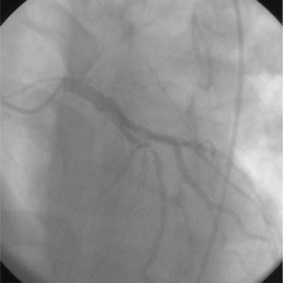 Figure 2 An anterior-posterior view of the left coronary system. The left anterior artery demonstrates a 95% stenosis after the first septal branch.