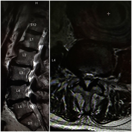 Figure 1 Lumbar Spine MRI: (A) sagittal T2WI showing degenerative disc changes with significant thecal sac compression at levels L5-S1, Magnification X1 (B) axial T2W at levels L4-L5 showing a massive AAA, Magnification X2.