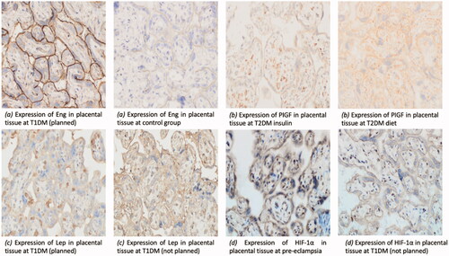 Figure 1. (a) – Eng expression in endotheliocytes and cytotrophoblast of chorionic villi; (b) – placental growth factor (PlGF) expression in the syncytiotrophoblast of chorionic villi; (с) – Lep expression in the syncytiotrophoblast and cytotrophoblast of chorionic villi; (d)- HIF-1αexpression is verified in the syncytiotrophoblast and cytotrophoblast of chorionic villi. Immune histochemical method, х 400.