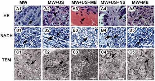 Figure 4. Microscopy images of selected tumour specimens in VX2 rabbit livers. (A) HE-stained images under the same magnification time (400 ×). Scale bar: 25 μm. A1, A5, mitosis of normal tumour nucleus (black arrows); A2, fragments of tumour nucleus (black arrow); A3, a mass of amorphous substance stained red homogeneously (black arrow); A4, interstitial hyperaemia and oedema (black arrow). (B) NADH-stained images of the same magnification time (400 ×). Scale bar: 25 μm. B1, normal tumour cells are stained (black arrow); B2, B4, sharp demarcations between the necrotic and non-necrotic regions (black arrows); B3, no staining in the ablated zone (black arrow). (C) TEM images. Scale bar: 5 μm. C1, C5, the integrated nuclear membrane (black arrows); C2, C4, obviously interrupted nuclear membrane (black arrows); C3, the cellular fragments in all around (black arrow).