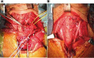 Figure 3. Radical resection was successfully performed preserving left common carotid artery.Image during surgery before (A) and after (B) tumor resection. (A) Although, the tumor size was remarkably reduced by LEN treatment, the tumor was still invasive in inferior and dorsal side, resulting in involvement of left venous angle. (B) Left CCA was successfully detached from tumor and preserved intact.BCV: Brachiocephalic vein; CCA: Common carotid artery; LEN: Lenvatinib; SCV: Subclavian vein.