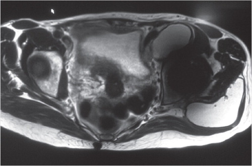 Figure 2. MRI of case 30, showing large fluid-filled pseudotumor.
