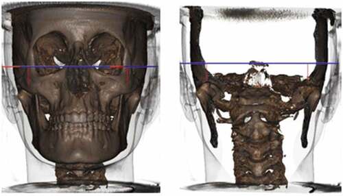 Figure 5. Image and measurements obtained by the SYM 3D protocol that allows the evaluation of Articular Fossa to Axial Plane (Articular Fossa-Pl. Axial).