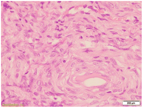 Figure 2: Microscopic appearance of mitotically active cellular fibroma.