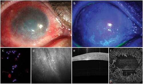 Figure 2. Clinical Appearance of Limbal Epithelial Stem Cell Deficiency (LSCD). LSCD is characterized clinically by loss of corneal clarity because of superficial neovascularization (a), positive fluorescein staining (b), presence of conjunctival cytokeratin (CK) markers on impression cytology (CK19) and immunohistochemistry (c), altered epithelial cell morphology with sub-basal fibrosis on in vivo confocal microscopy (d), replacement of the dark hyporeflective corneal epithelial phenotype with bright and thick conjunctival phenotype on optical coherence tomography (OCT, E) and loss of normal limbal vascular architecture on OCT angiography (F).