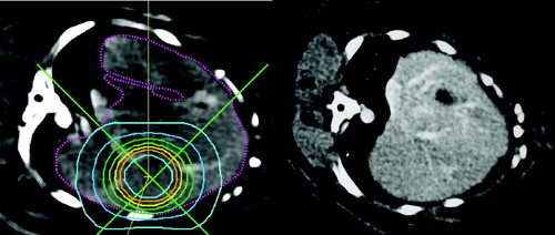 Figure 2.  Treatment plan for a stereotactic liver irradiation (left): The inner circle corresponds to the 80% isodose (36 Gy), the following circles correspond to the 70%, 60%, 60%, 50%, 40%, 30% and 20% isodose lines. Right: CT examination 2 months after irradiation: no radiological reaction is visible.