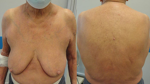 Figure 5 Already after the first cycle of mogamulizumab the patient achieved prompt clinical response with >90% clearance of skin disease.