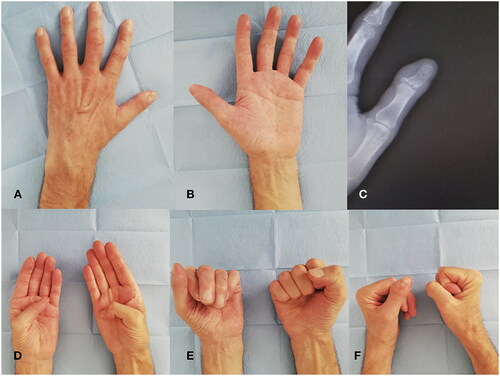 Figure 2. Tamai zone 2 thumb replantation 1 year post. (A) Dorsal view; (B) Volar view; (C) X-Rays view; (D) Kapandji score evaluation; (E) Thumb flexion volar view; (F) Thumb flexion dorsal view.