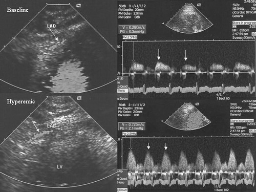 Figure 1 Mid to distal segment of LAD in color‐coded transthoracic Doppler echocardiography, spectral Doppler coronary blood flow by sampling in mid to distal segment of LAD.