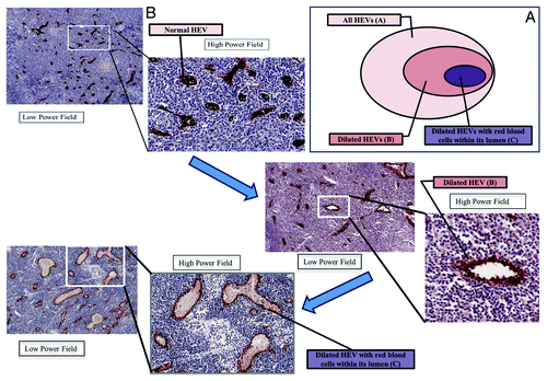 Figure 1. Definitions of the high endothelial venules (HEV) parameters and its ratios (A) and metamorphosis spectrum of HEV in a nodal microenvironment (B). (A) Venn diagram illustrating the relationship between HEV and their different morphological forms. (B) Immunohistochemistry of lymph nodes (LN) showing the different HEV morphology stained by MECA-79 and the spectrum from a normal appearing HEV (normal LN) to an abnormal/ modified HEV in a LN in the presence of cancer (but no LN mets) to lastly a LN with frank LN metastases.