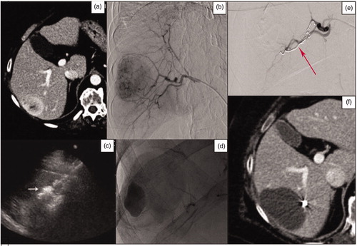 Figure 1. (a) Axial pretreatment post-contrast CT-image of a 72-year-old woman, showing a metastasis in the VI hepatic segment originating from a leiomyosarcoma. (b) Selective diagnostic hepatic angiography showing the right hepatic artery and the feeding vessels to the liver metastasis. (c) US image performed during the MWA procedure showing the antenna correctly inserted into the liver tumor. (d) The post-embolization angiography shows a contrast leak, successfully treated using microcoils. (e) The selective diagnostic hepatic angiography shows the embolization with coils of the bleeding vessel. (f) 1-month axial CT-image control showing no residual tumor.