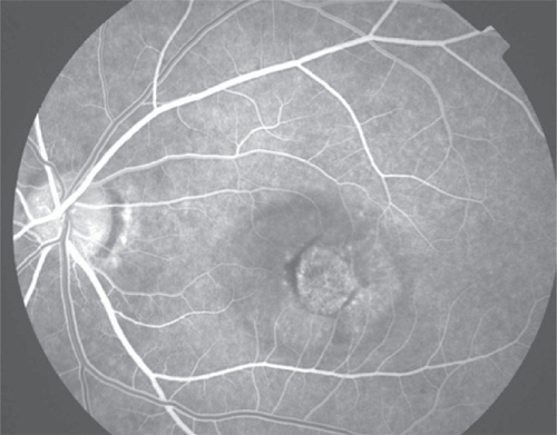 Figure 3b Early arteriovenous phase fluorescein angiogram demonstrating early central hyperfluorescence of the choroidal neovascularization. Note blockage of fluorescence by hemorrhage and relative lack of fluorescence in surrounding subretinal fluid.