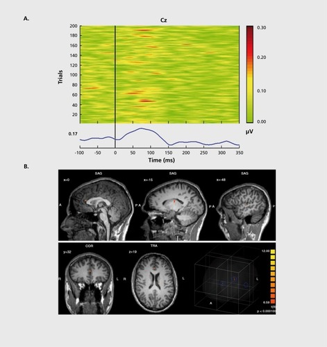 Figure 1. EEG-informed fMRI analysis in an auditory choice reaction task. A) EEG single-trial data of a typical data set at electrode Cz. In many trials, a GBR between 30 and 100 ms post-stimulus is present. However, the amplitudes of the GBR are variable over time. This variability can be used for specific predictions of the related BOLD signal. In the lower part of the figure, the corresponding averaged GBR is shown. B) GBR-specific BOLD activation based on the single-trial coupling of GBR amplitude variation and corresponding BOLD activation. Activations can be seen in the left auditory cortex (gyrus temporalis superior; Brodmann area 41/22, highest t-value 8.3), the thalamus (highest t-value 7.6) and the anterior cingulate cortex (Brodmann area 24, highest t-value 10.1). In the lower right corner, a glass brain view is provided, demonstrating a 3D view of the three abovementioned clusters. Activations are shown at P<0.0001 (random effects analysis, uncorrected for multiple testing). EEG, electroencephalography; fMRI, functional magnetic resonance imaging; GBR, gamma-band response; BOLD, blood oxygenation level-dependent Reproduced from ref 14: Mulert C, Leicht G, Hepp P, et al. Single-trial coupling of the gamma-band response and the corresponding BOLD signal. Neuroimage. 2010;49:2238-2247. Copyright © Elsevier 2010