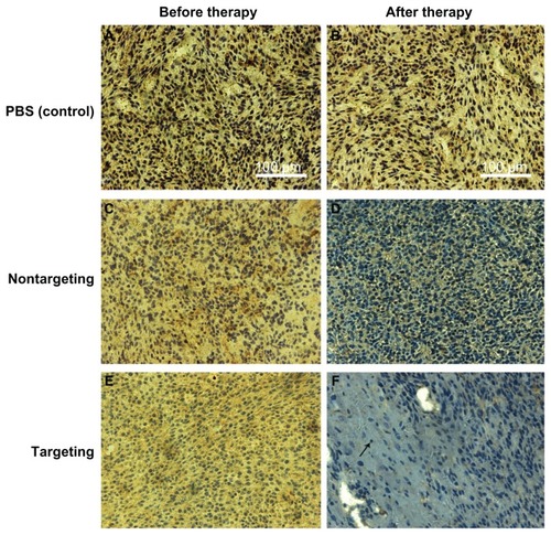 Figure 10 Immunohistological characteristics of SK-N-SH tumors (sections were immunostained with Bcl-2 monoclonal antibodies). The brown stains indicated Bcl-2 protein. (A and B) PBS control, (C and D) nontargeting polyplex therapy, (E and F) targeting polyplex therapy. The black arrow mark apoptotic cell with condensation or nuclei fragmentation.Abbreviation: PBS, phosphate buffered saline.