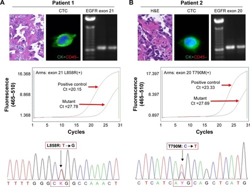 Figure 5 EGFR L858R (exon 21) and T790M (exon 20) sequencing of primary tissues and CTCs.Notes: (A) PCR of exon 21 was successfully performed and a band of proper size was found with 2% gel electrophoresis. ARM-PCR and Sanger sequencing were used to detect the mutation sites in L858R. (B) PCR of exon 20 was successfully performed and a band of proper size was found with 2% gel electrophoresis. ARM-PCR and Sanger sequencing were used to detect the mutation sites in T790M.Abbreviations: ARM-PCR, amplification refractory mutation system PCR; CTCs, circulating tumor cells; EGFR, epidermal growth factor receptor; PCR, polymerase chain reaction.