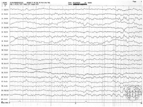Figure 2: EEG of Patient 4