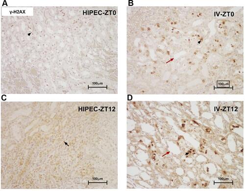 Figure 4 Representative microphotographs of anti-γ-H2AX-stained kidney sections, illustrating samples from: (A) group receiving HIPEC with cisplatin at 08:00 (ZT0), (B) group receiving IV cisplatin at 08:00 (ZT0), (C) group receiving HIPEC with cisplatin at 20:00 (ZT12), (D) group receiving IV cisplatin at 20:00 (ZT12). Black arrows: positively stained nuclei; red arrows: cystic tubular changes (×200).