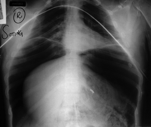 Figure 1: An X-ray of the chest and abdomen (taken in the sitting position)