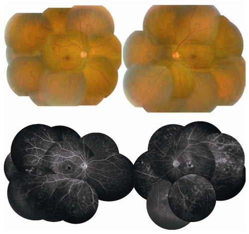 Figure 4 Fundus photographs and fluorescein angiograms 6 months after treatment.