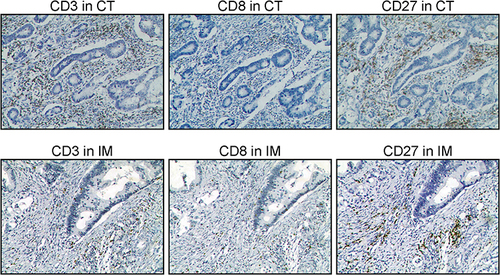 Figure 2 Representative IHC staining of CD3, CD8, and CD27 in the same place at the same time, namely in the core of the tumor (CT) and in the tumor’s invasive margin (IM) in colon tumor tissue (100×).