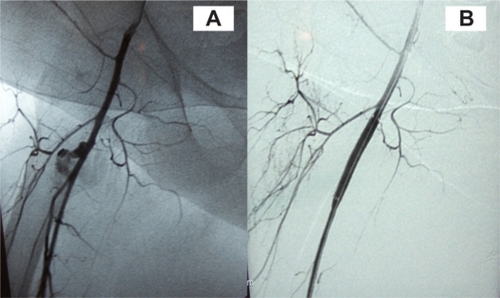 Figure 2 Case 2. A) Active extravasation from the deep femoral artery just beyond the common femoral bifurcation. B) successful control of the bleeding after stent deployment.