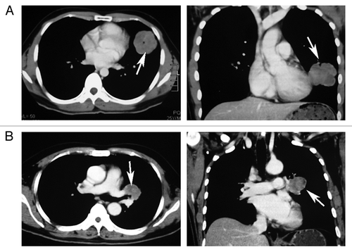 Figure 1. Chest CT. (A) Case 1. There is a homogeneous peripheral mass in the left lower lobe of lung (white arrows). (B) Case 2. There is a 3.6-cm popcorn-like hilar mass located in the left upper lobe of the lung (white arrows).