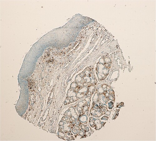 Figure 3. Absent CD44 expression in normal laryngeal epithelium