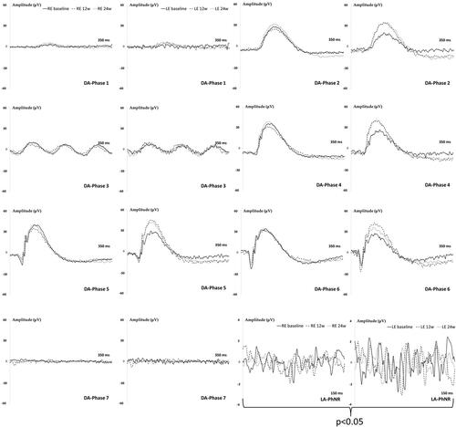 Figure 6. Neuroretina functionality, measured by dark- and light-adapted electroretinography (ERG), in the dexamethasone-fibronectin co-loaded microspheres (MsDexaFibro) model over 6 months of follow-up. MsDexafibro: microspheres loaded with dexamethasone and fibronectin; RE: right eye; LE: left eye; w: week; DA: dark-adapted; LA: light-adapted; μV: microvolts; ms: milliseconds.