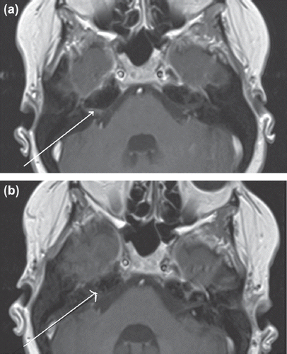 Figure 1. (a) Pre-treatment axial T1 weighted post-contrast MR image of the brain. The arrow points to enhancement caused by tumor deposits. (b) Post-treatment axial T1 weighted post-contrast MR image of the brain – indicates interval response to treatment.