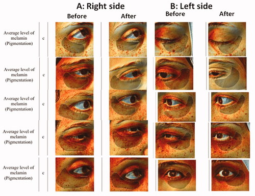 Figure 5. Samples of Antera 3D® Camera photos of before and after treatment with: (A) Right side (MAP niosoma gel) and (B) Left side (MAP ethosoal gel).