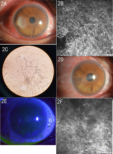Figure 2 Preoperative and postoperative observed corneal conditions. (A) The patient’s corneal ulcer was formed, with visible bacterial moss and pseudopodia. (B) A large number of filamentous high-density shadows (fungal hyphae) can be seen under a confocal microscope. (C) 1% KOH wet film of ulcer scrapings shows mycelium structure under the microscope. (D) The patient’s ulcer surface was clean after debridement with the low-temperature plasma surgery system. (E) Fluorescence staining of the cornea at post-operative Week 2 shows the healing of the corneal ulcer and complete epithelial repair. (F) In vivo confocal microscopy examination at post-operative Week 2 reveals no clear hyphal structures.