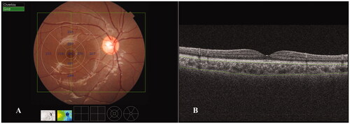 Figure 1. Choroidal thickness (ChT) measurements obtained using swept-source optical coherence tomography in the macular region. (A) ChT measurements in the ETDRS grid in the macular region. The mean ChT (μm) for each sector is shown in the grid. A wide three-dimensional mode, which consisted of 256 scan lines (vertical green line) in a 12 mm × 9 mm scan area (green rectangle), was adopted in the current study. (B) ChT was defined as the vertical distance between Bruch’s membrane (upper green line) and the choroid-scleral interface (lower green line).